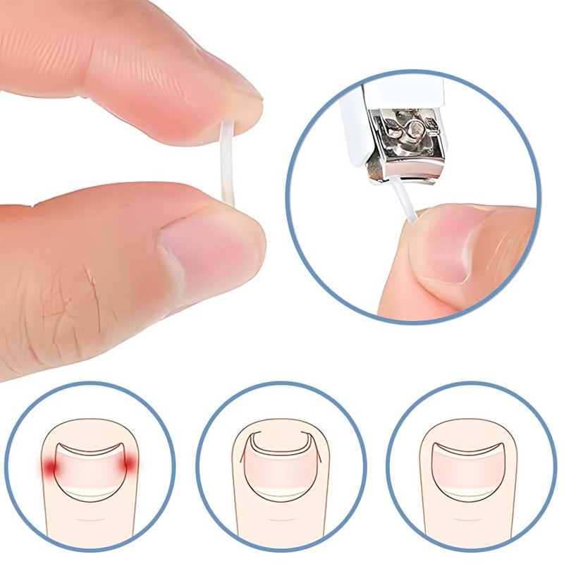 Ingrown Toenail Correction Set of 50 Toenails Toenail Correction for