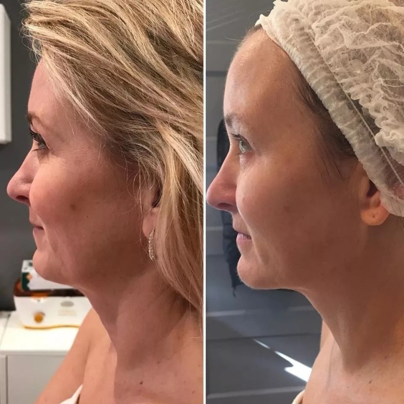 Mini Hifu Hifu Mini 2th Generation Lifting Facial Radiofrecuencia Sms