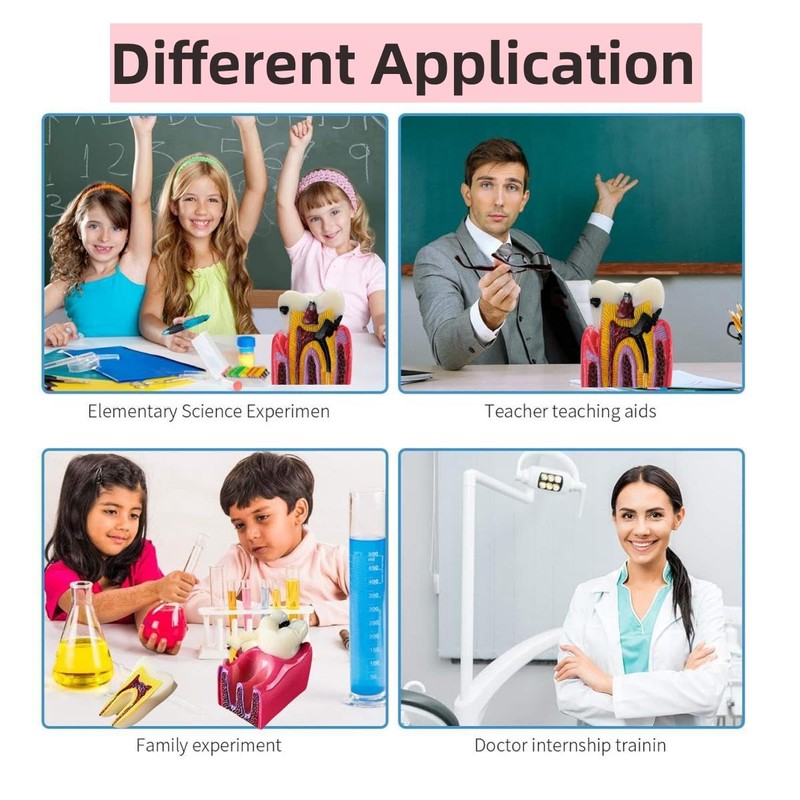 6 Times Dental Caries Model Teaching Typodont Tool for Dentists,