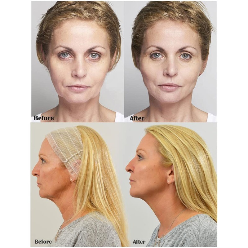 CeFurisy Collagen Silk Threads for Lifting Thread Lifting for Skin