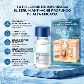 Acne Buster Loción Secante Con Ácido Salicílico 10ml Todo Tipo De Piel Díanoche                                                                       