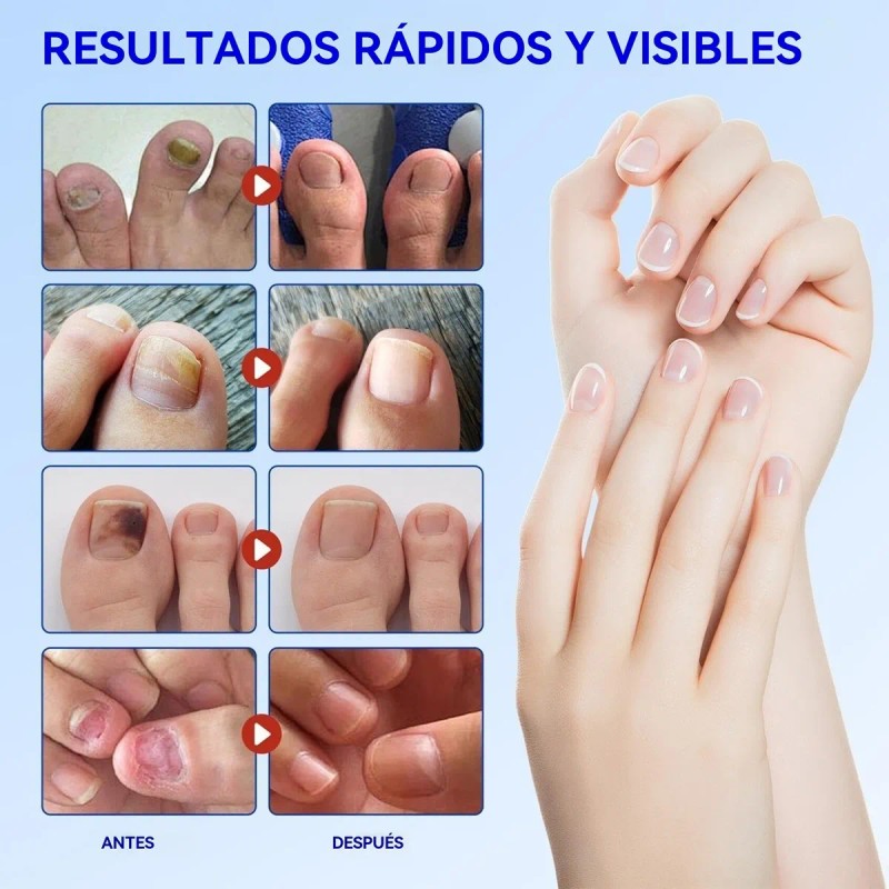 Jf Parches De Uñas Fúngicas, 63pcs De Tratamiento