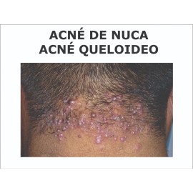 Acné De Nuca Queloideo Tratamiento Auxiliar Neutra