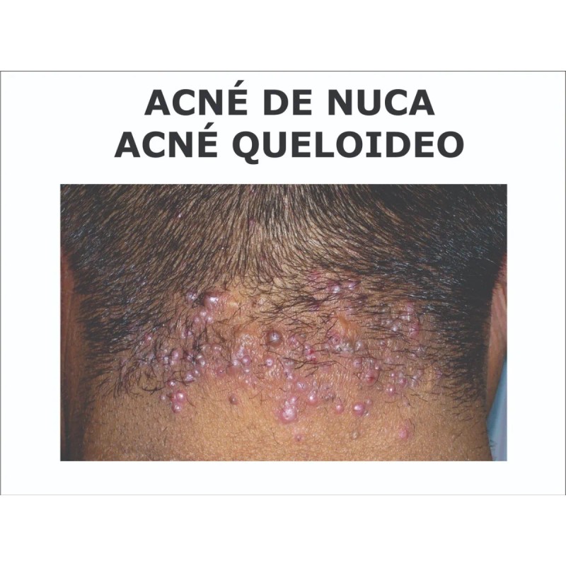 Acné De Nuca Queloideo Tratamiento Auxiliar Neutra