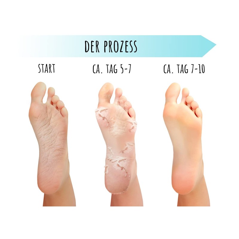 Summer Foot Premium callus socks, callus foot mask, mask for