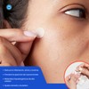 Parches para Acné - Parches Hidrocoloides Absorbentes - Ideal para