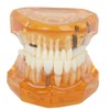 Dental Model for Teaching, Bit Model of Dental Degeneration Demonstration