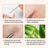 Atomus Blackhead Remover Tool Kit, 8 Pieces Professional Pimple Extractor