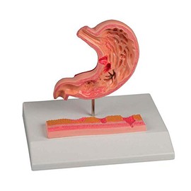 Erler Zimmer Stomach with Ulcer Anatomy Model Stomach Mucosal Inflammation Stomach Ulcer