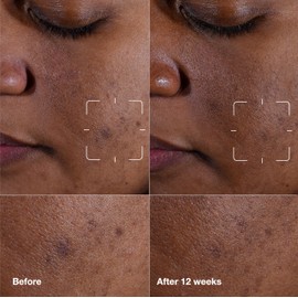 Clinique Even Better Clinical Dark Spot Clearing Serum With Vitamin C | Brightening + Soothing, 1.7 Fl Oz