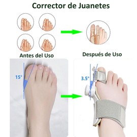 Corrector de Juanetes y Separadores de Dedos de Pie Ortopédicos, 1 Férula Ajustable, 2 Separadores, para mujeres y hombres