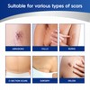MURASAKI BEAUTY Silicone Scar Tape & Sheets – Removal on