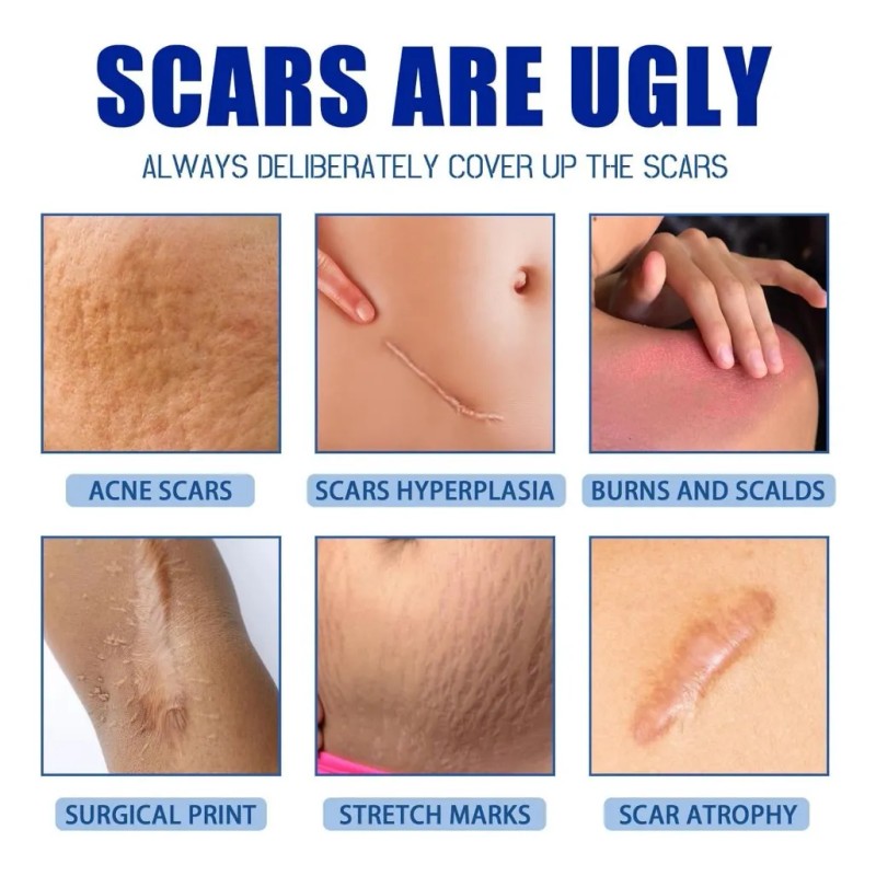 2 Cremas Para Cicatrices, Gel De Silicona Para Cicatrices,