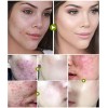 Tratamiento Acne Puntos Negros Manchas Cicatrices Barros