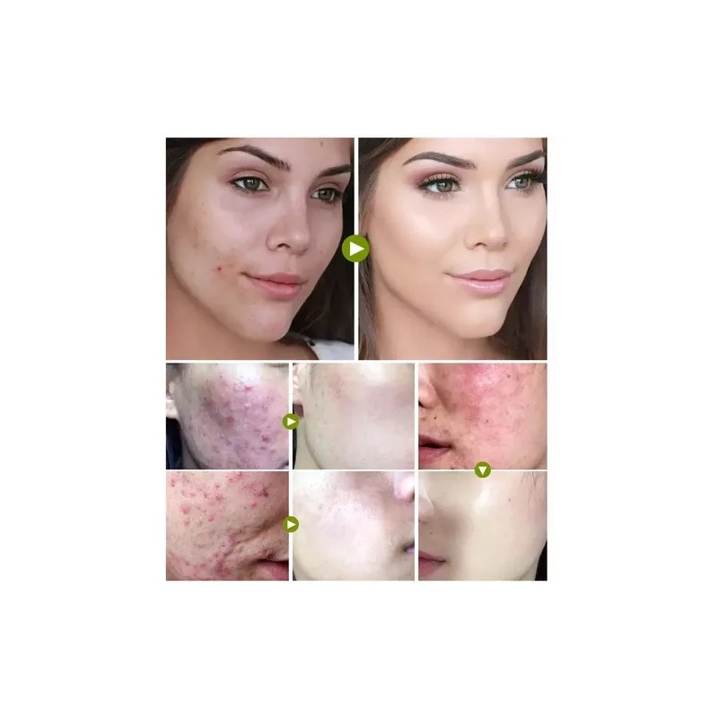 Tratamiento Acne Puntos Negros Manchas Cicatrices Barros