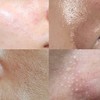 Anasis Acleon Seboex Sebum Absorption Whitehead Acne Toner Acne Acne