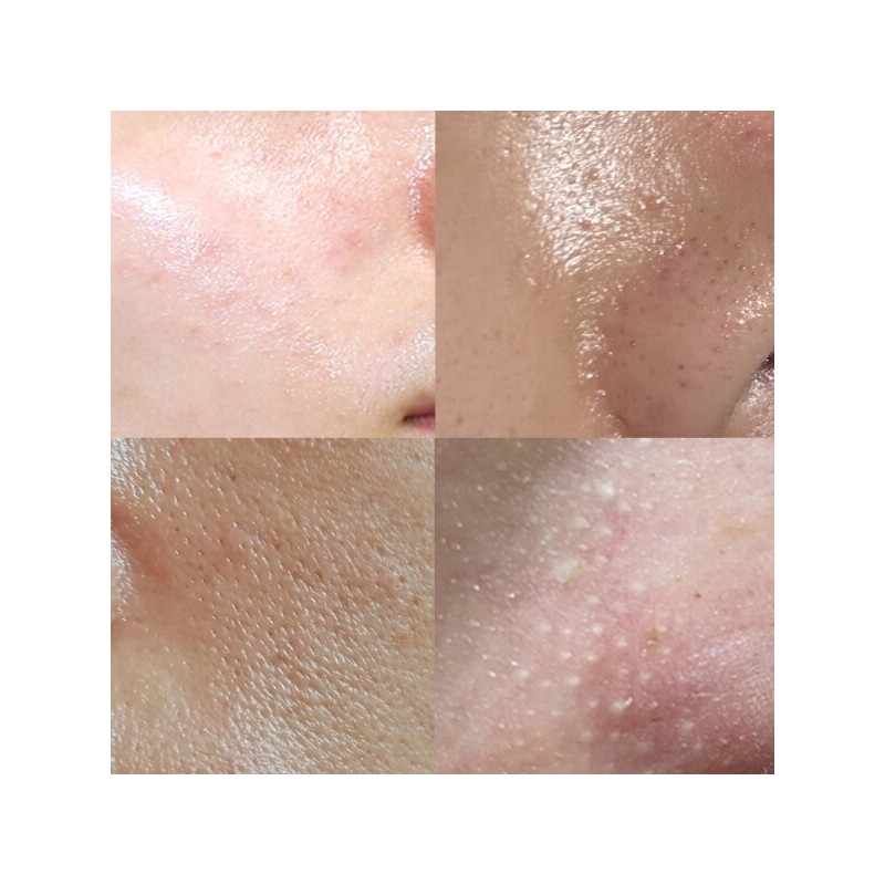 Anasis Acleon Seboex Sebum Absorption Whitehead Acne Toner Acne Acne
