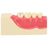 Right Lower Posterior Tooth Model 2X Magnification Detachable Resin Tooth