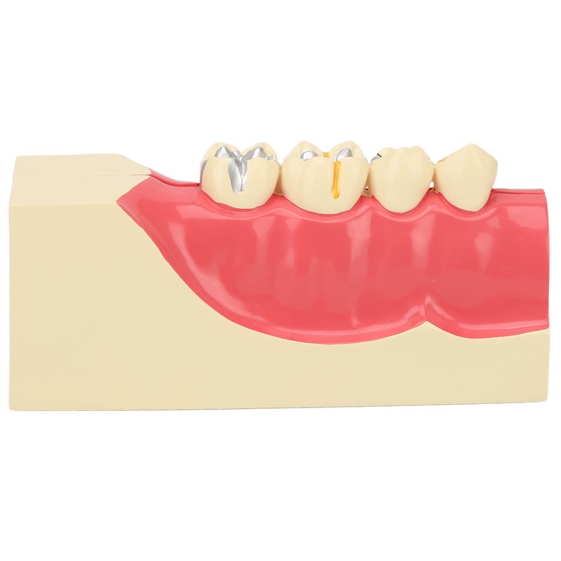 Right Lower Posterior Tooth Model 2X Magnification Detachable Resin Tooth