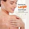 TKTK Large Acne Patches 45 mm XL Pimple Patches Big