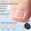 Professional Ingrown Toenail Set with Breathable Ingrown Toenail Strips, Curved