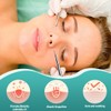 2 Acne Pimple Tweezers Blackhead Remover, Comedone Squeezer, Blackhead Remover,