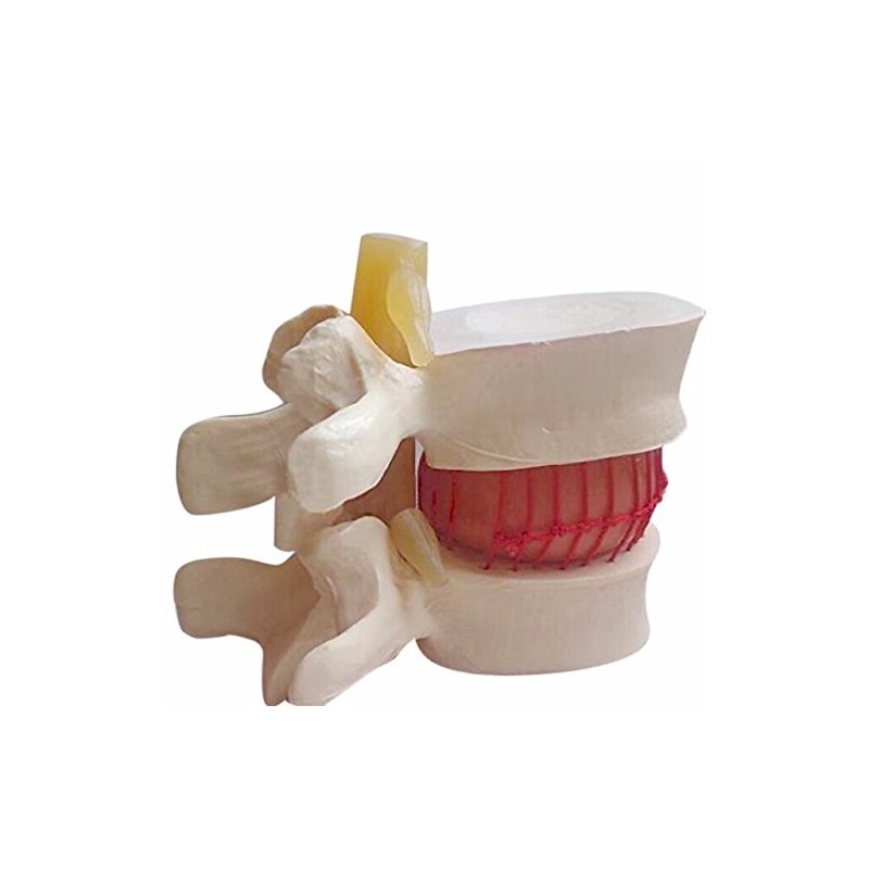 BoNew 1:1.5 Anatomical Human Lumbar Vertebrae Degenerative Lumbar Human Spine