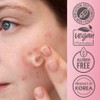 Purederm Blemish Spot Treatment Gel with Salicylic Acid 2%, Soothing