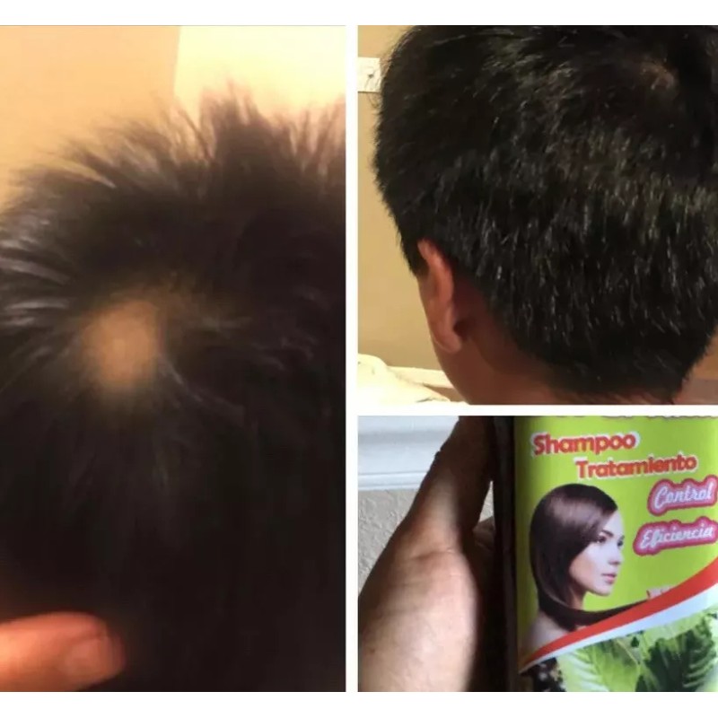 Vanessa Producto 100% Natural Mexicano 2 BOTTLES, HAIR REGROWTH SHAMPOO
