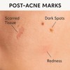 PUREEASE Post-Acne Spot Pimple Patch C Prevents & Fades Dark