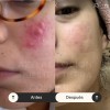 Controla El Acne Matifica Desinflama Rosacea Locion Azelaico Momento de