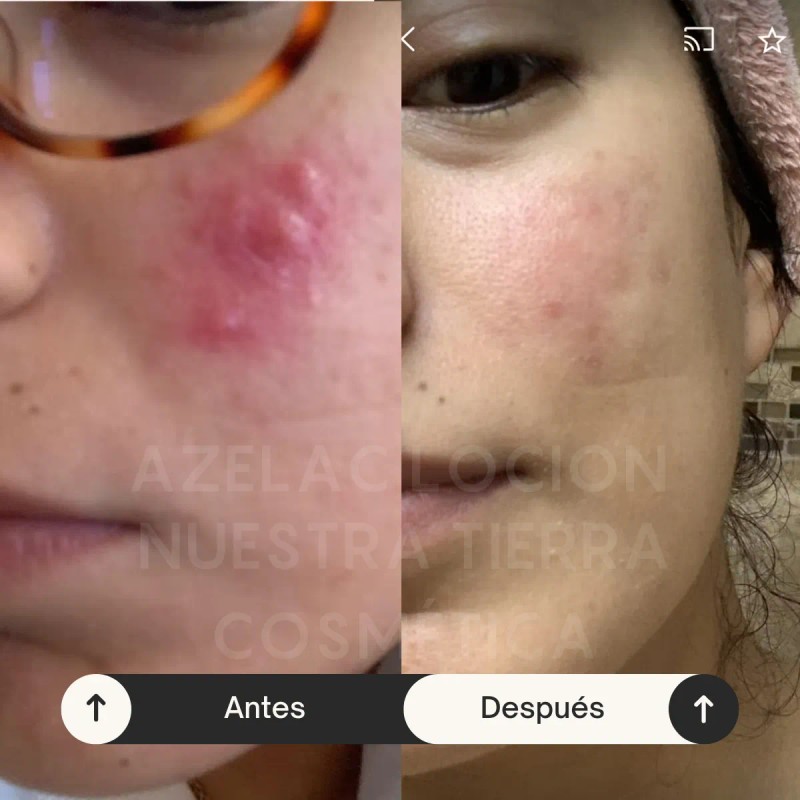Controla El Acne Matifica Desinflama Rosacea Locion Azelaico Momento de
