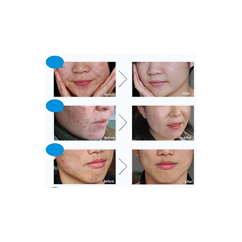 Bioaqua Acne Cream Cicatrices Poros Control De Grasa 1 Pzs