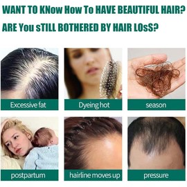 Suero De Ginseng Para El Crecimiento Del Cabello, Suero De Jengibre Para El Crecimiento Del Cabello, Esencia Para El Crecimiento Del Cabello, Para Mujeres Hombres Todo Tipo De Cabello (1)