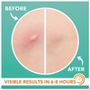 Glow Drift Acne Patches – 36 Count | Korean-Inspired Invisible