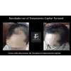 Solución Anticaida Para Hombre Con Cabello Con Caspa
