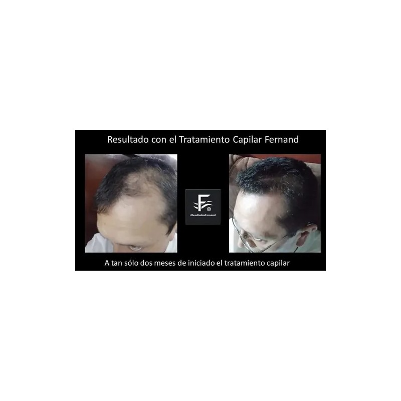 Solución Anticaida Para Hombre Con Cabello Con Caspa