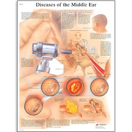 3B Scientific VR1252UU Glossy Paper Diseases of The Middle Ear Anatomical Chart, Poster Size 20" Width x 26" Height