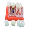 Dental Implant Educational Model, 4X Size, Demonstration Crown and Bridge