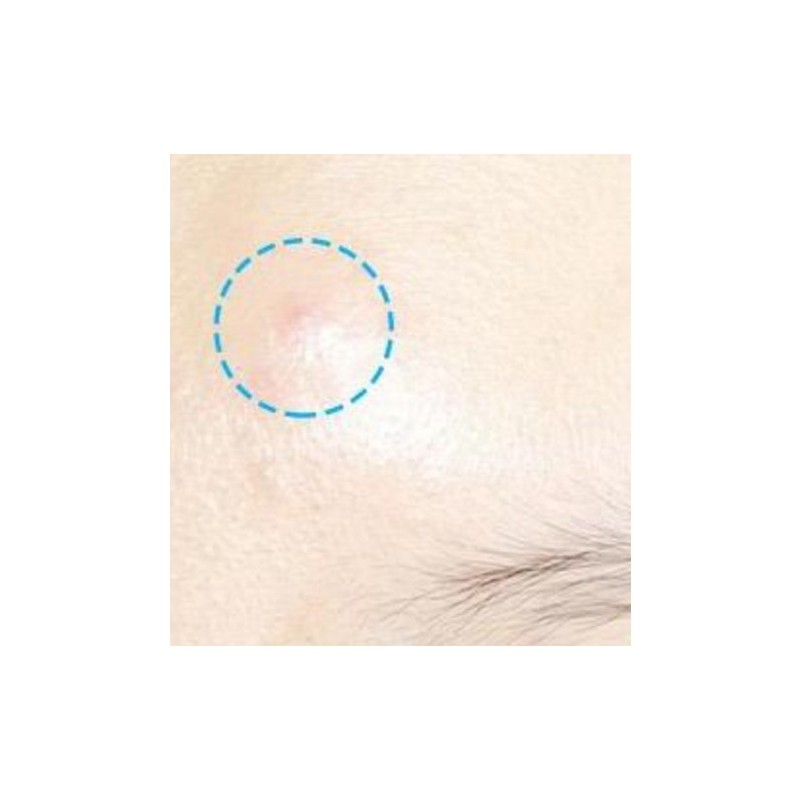 Hatherine Spot Care Patch Kit, 76 patches, 2 packs 해서린