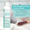 Ebanel Professional Callus Remover for Feet with 20% Urea, Epsom