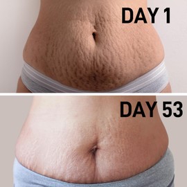 AOAO Aceite Para Estrías Durante El Embarazo Y Aceite Corporal Para Embarazadas. Aceite De Nuez De Marruecos Para Eliminar Y Prevenir Cicatrices Y Estrías. Crema Abdominal Para Reparar, Reafirmar Y