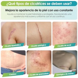 Parches de Silicona para Cicatrices, Lminas de Silicona Reutilizables para Reducir la Apariencia de Cicatrices, Cesrea, Ciruga, Acn y Estras, Suaves  