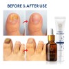 Tratamiento De Hongos En Las Uñas De Los Pies Extra