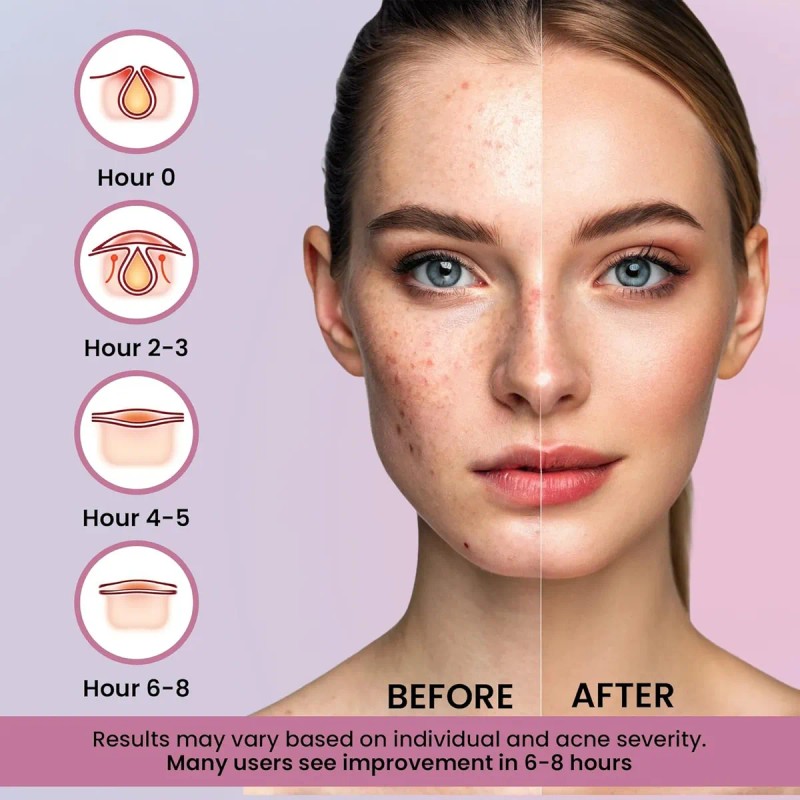 260 Parches De Espinillas Para Cara, Parches Hidrocoloides P