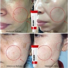 Crema coreana para el tratamiento del melasma, melanón, 30 ml. Tiempo de aplicación: piel nocturna, manchas y melasma