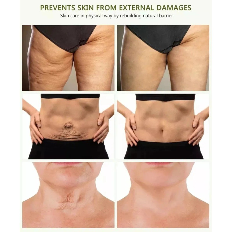 Adelgaza Abdomen Quemagrasa Celulitis Estrias Piernas Gluteo Neutra