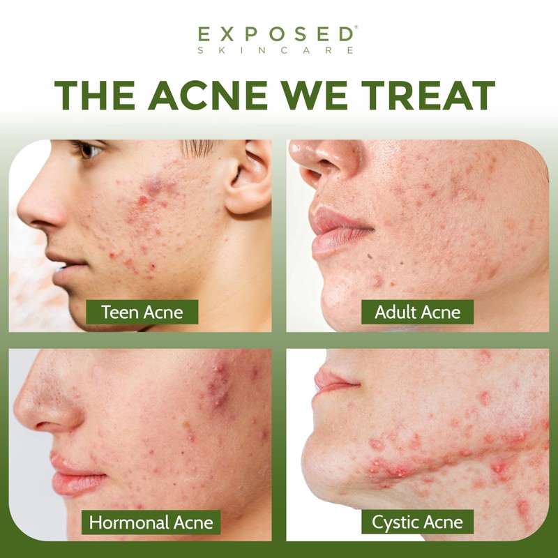 Exposed Skin Care Probiotic Supplement Complex with 1 Billion CFU