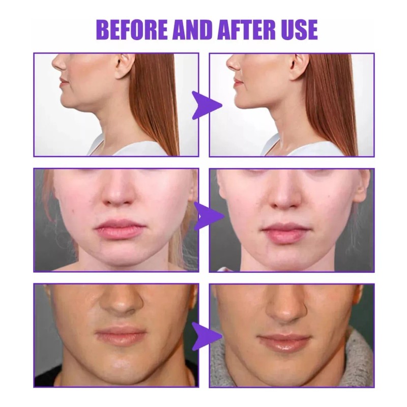 Tratamiento Crema Elimina Papada Moldea El Rostro No Serum Todo