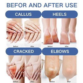 60% Urea Foot Cream - Deeply Moisturizes & Repairs Cracked Heels, Dry Skin - Urea Cream 60 Percent for Feet and Hands - Fast-Acting Foot Moisturizer for Soft, Smooth Feet